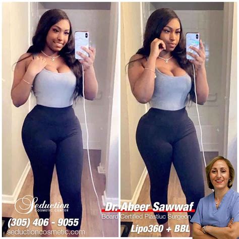 seduction cosmetic center photos|Liposuction Before and After Photos